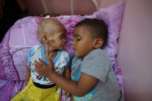 Yemen-children-undernourished-war