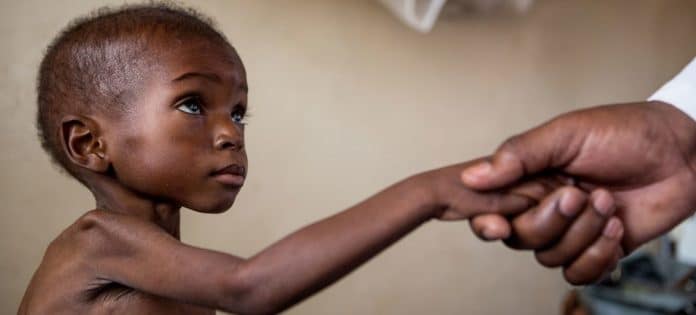 A doctor treats a toddler suffering from severe acute malnutrition and HIV at a local hospital in Katanga, DR Congo.