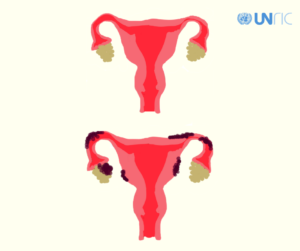 Endometrioosi