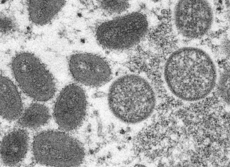 Il vaiolo delle scimmie è un'infezione rara ma pericolosa simile al virus del vaiolo ora sradicato.