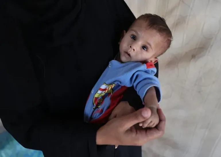 Veldig underernært babe fra Gaza